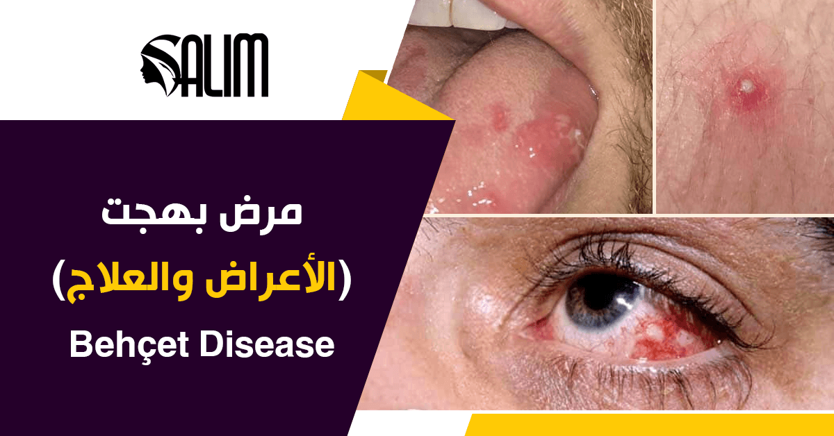 مرض بهجت (Behçet Disease): الأسباب، الأعراض، وأحدث طرق العلاج | د. سالم ...